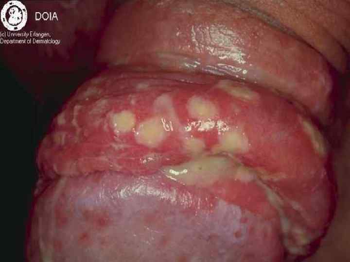 Типичная локализация у мужчин на головке полового члена, венечной борозде, в уретре, на теле