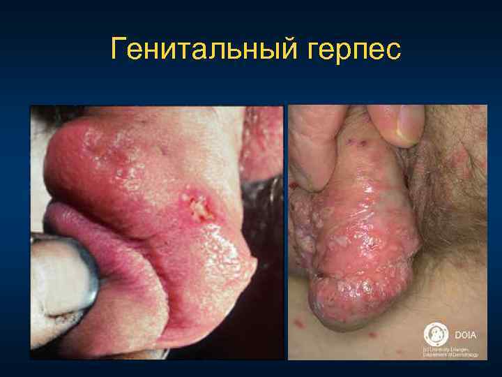 Генитальный герпес 
