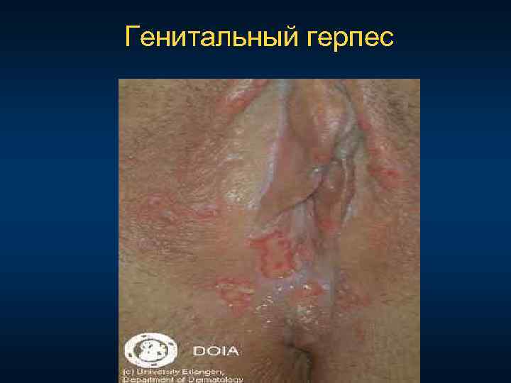 Генитальный герпес 