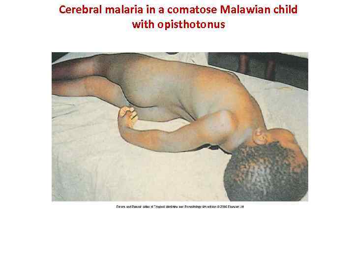 Cerebral malaria in a comatose Malawian child with opisthotonus 