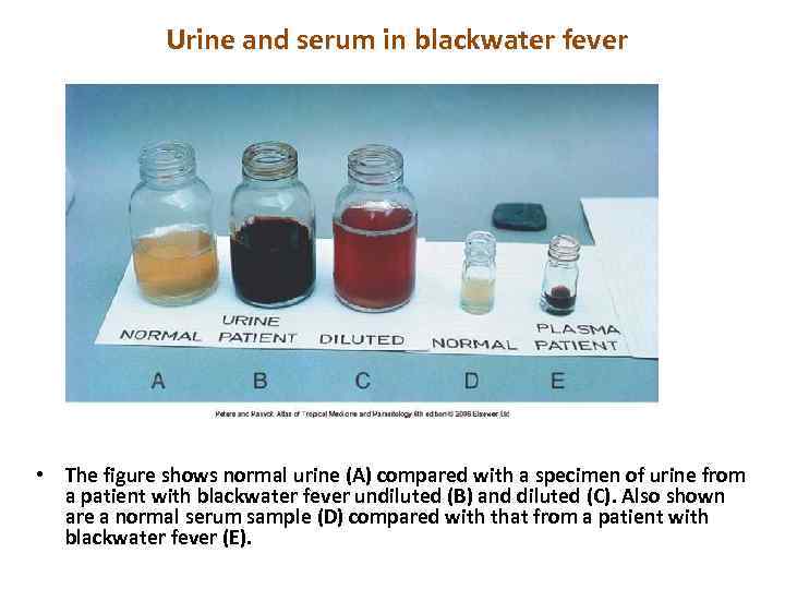 Urine and serum in blackwater fever • The figure shows normal urine (A) compared