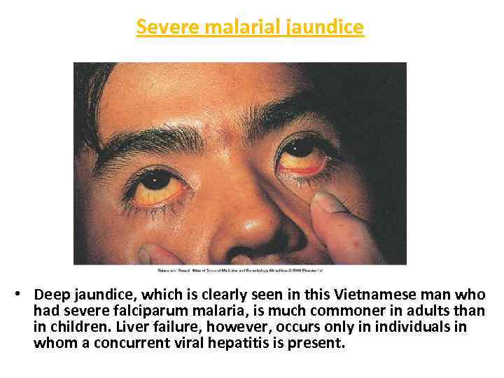 Severe malarial jaundice • Deep jaundice, which is clearly seen in this Vietnamese man