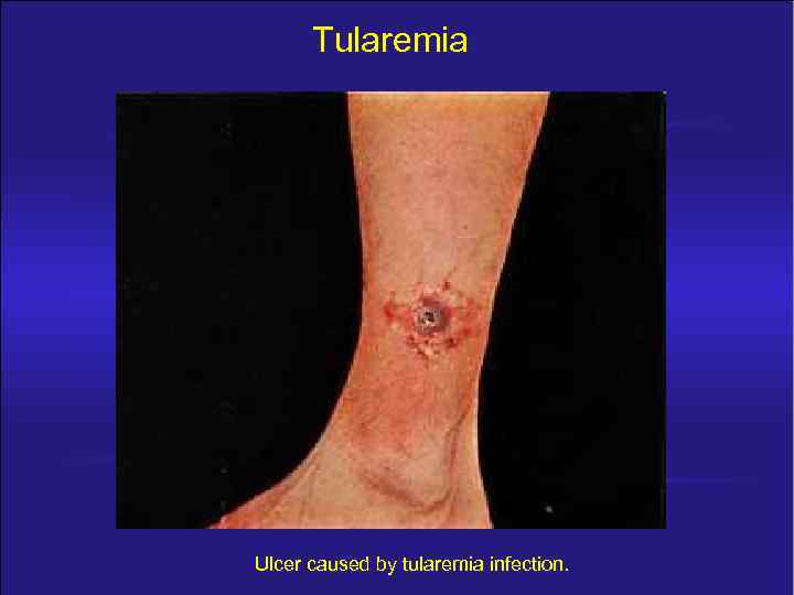 Tularemia Ulcer caused by tularemia infection. 