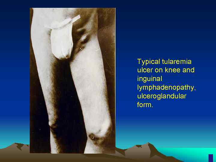 Typical tularemia ulcer on knee and inguinal lymphadenopathy, ulceroglandular form. 