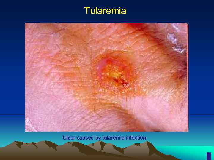 Tularemia Ulcer caused by tularemia infection. 