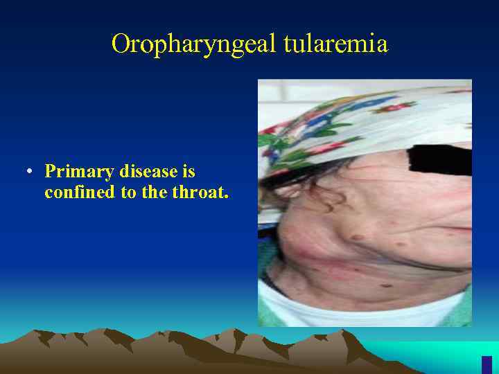 Oropharyngeal tularemia • Primary disease is confined to the throat. 