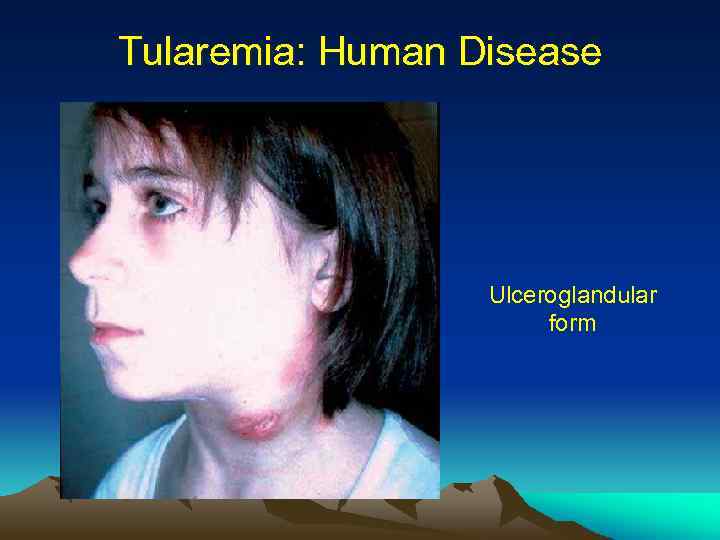 Tularemia: Human Disease Ulceroglandular form 