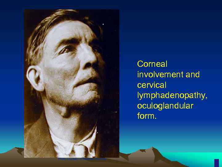 Corneal involvement and cervical lymphadenopathy, oculoglandular form. Photo courtesy of National Archives 