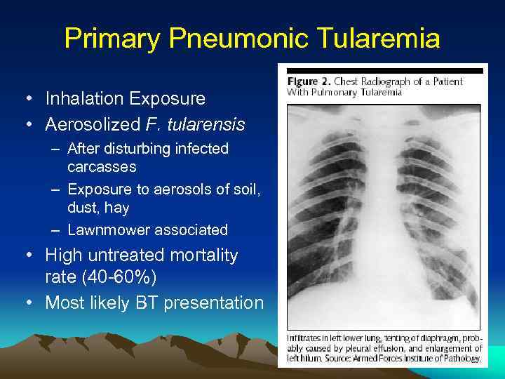 Primary Pneumonic Tularemia • Inhalation Exposure • Aerosolized F. tularensis – After disturbing infected