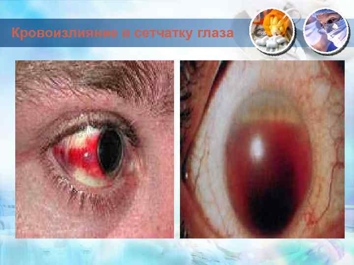 Кровоизлияние в сетчатку глаза 