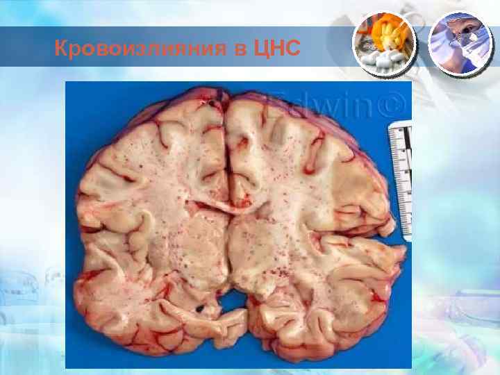 Кровоизлияния в ЦНС 