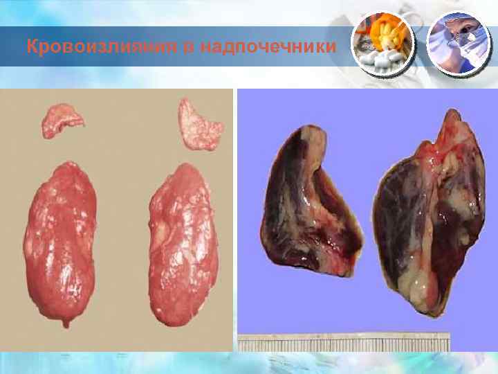 Кровоизлияния в надпочечники 