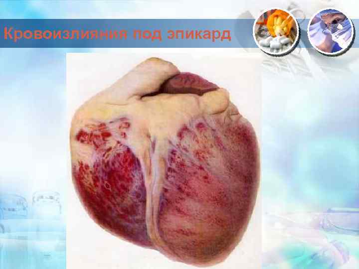 Кровоизлияния под эпикард 