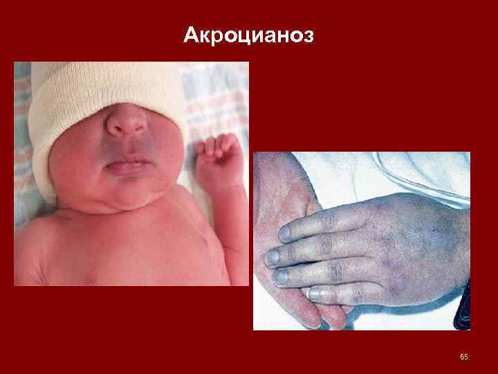 Акроцианоз 65 