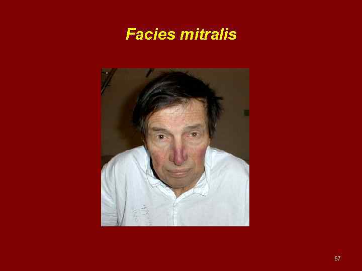 Facies mitralis 67 