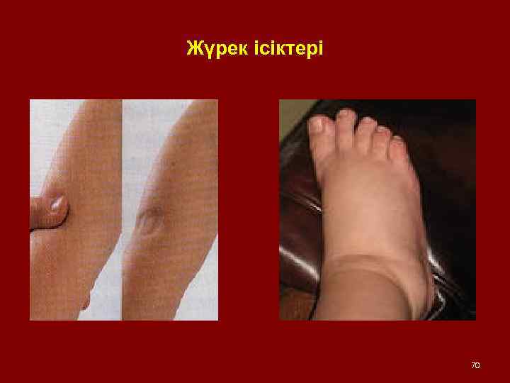 Жүрек ісіктері 70 