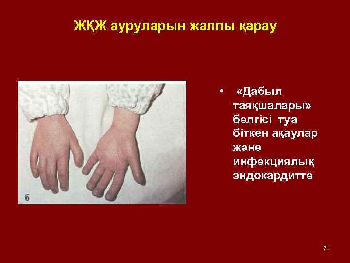 ЖҚЖ ауруларын жалпы қарау • «Дабыл таяқшалары» белгісі туа біткен ақаулар және инфекциялық эндокардитте