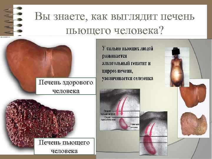 Вы знаете, как выглядит печень пьющего человека? Печень здорового человека Печень пьющего человека 