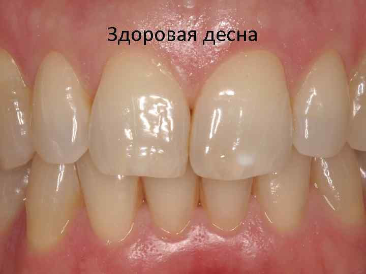 Здоровая десна 