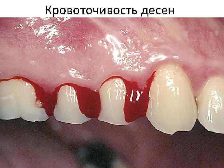 Кровоточивость десен 