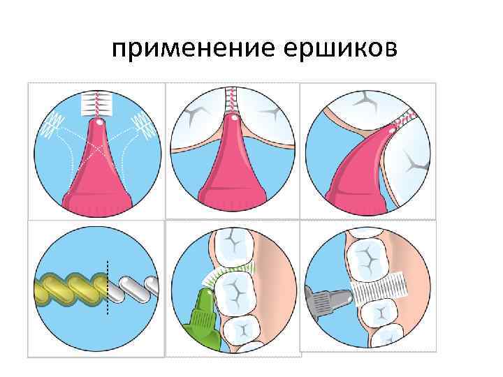 применение ершиков 