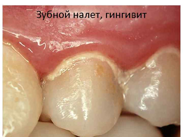 Зубной налет, гингивит 