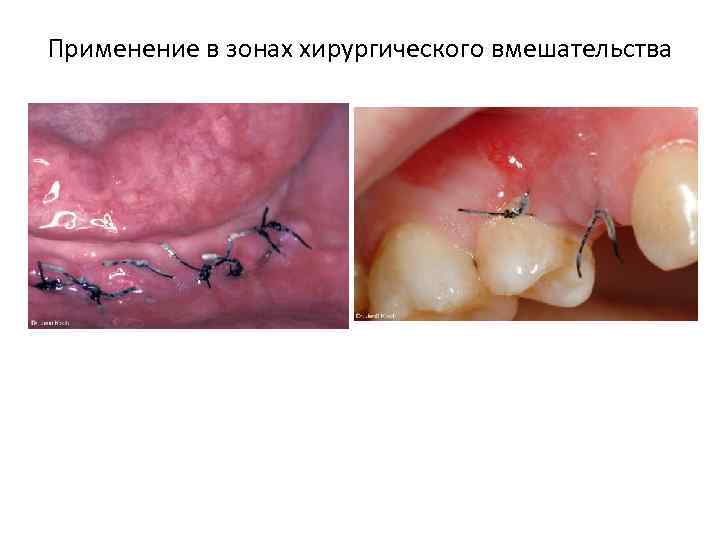 Применение в зонах хирургического вмешательства 
