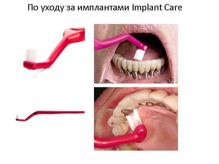 По уходу за имплантами Implant Care 