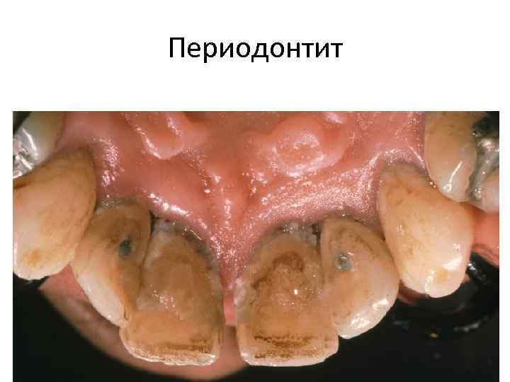 Периодонтит 