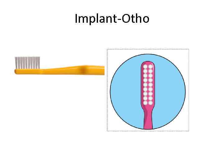 Implant-Otho 