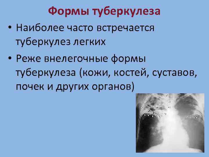 Формы туберкулеза • Наиболее часто встречается туберкулез легких • Реже внелегочные формы туберкулеза (кожи,