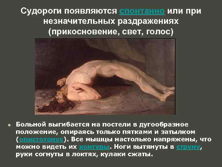 Судороги появляются спонтанно или при незначительных раздражениях (прикосновение, свет, голос) u Больной выгибается на