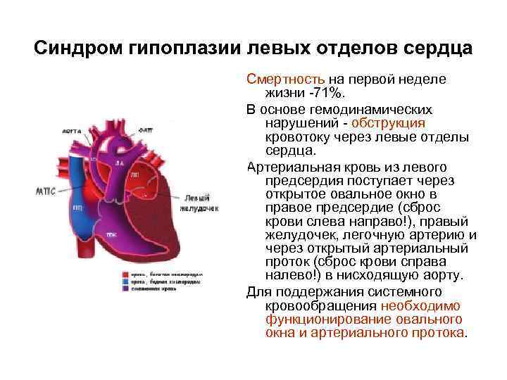 Левых отделов. Гипоплазия левых отделов сердца. СГЛОС синдром гипоплазии левых отделов сердца. Гипоплазия предсердия.