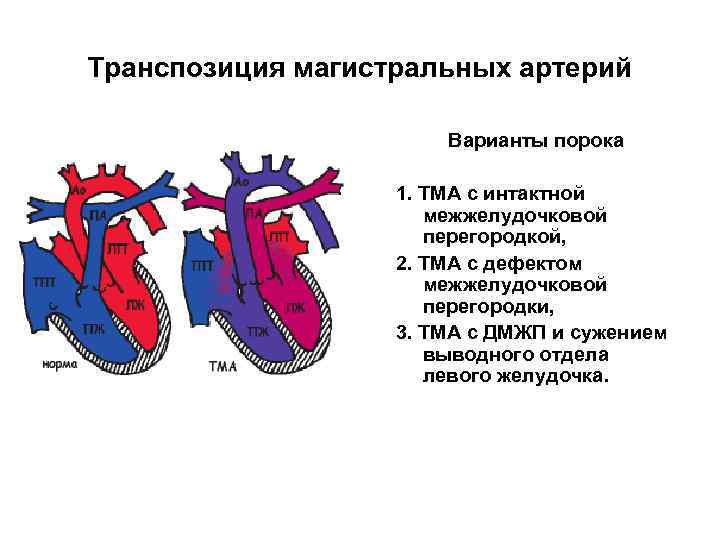 Транспозиция магистральных артерий Варианты порока 1. ТМА с интактной межжелудочковой перегородкой, 2. ТМА с