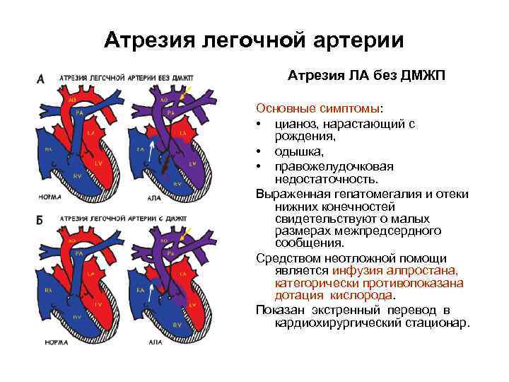 Стеноз легочной артерии. Пороки сердца - атрезия легочной артерии классификация. Атрезия легочной артерии 1 Тип ДМЖП. Инфундибулярный дефект межжелудочковой перегородки. Атрезия клапана легочной артерии 1 типа.