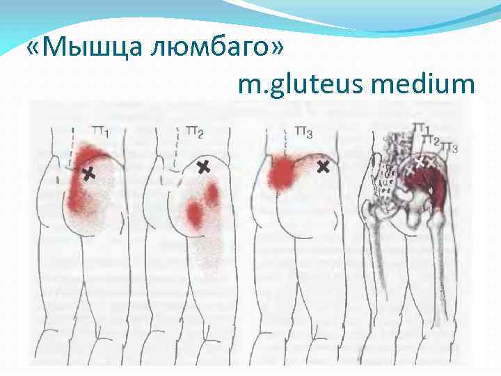  «Мышца люмбаго» m. gluteus medium 