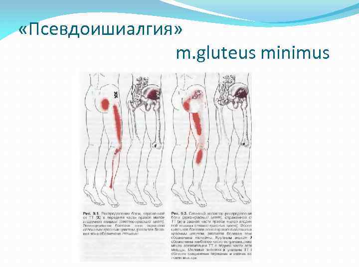  «Псевдоишиалгия» m. gluteus minimus 