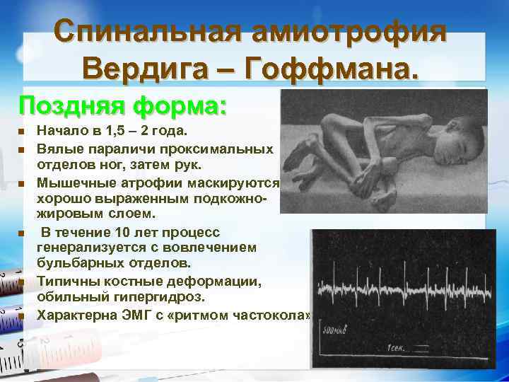 Спинальная амиотрофия Вердига – Гоффмана. Поздняя форма: n n n Начало в 1, 5