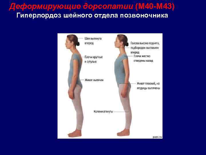  Деформирующие дорсопатии (М 40 -М 43) Гиперлордоз шейного отдела позвоночника 
