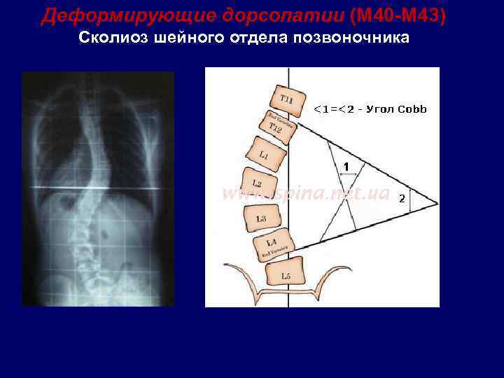 Дорсопатия шейного. Дорсопатия шейного отдела позвоночника. Дорсопатии шейного отдела позвоночника. Вертеброгенная дорсопатия шейного отдела позвоночника. Дорсопатия на шейном уровне.