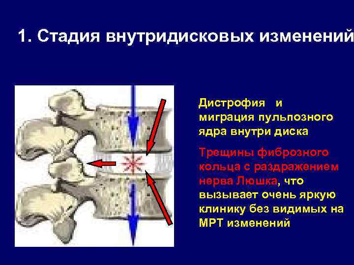 1. Стадия внутридисковых изменений Дистрофия и миграция пульпозного ядра внутри диска Трещины фиброзного кольца