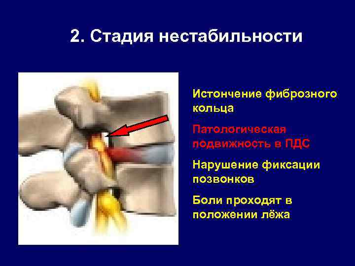 2. Стадия нестабильности Истончение фиброзного кольца Патологическая подвижность в ПДС Нарушение фиксации позвонков Боли
