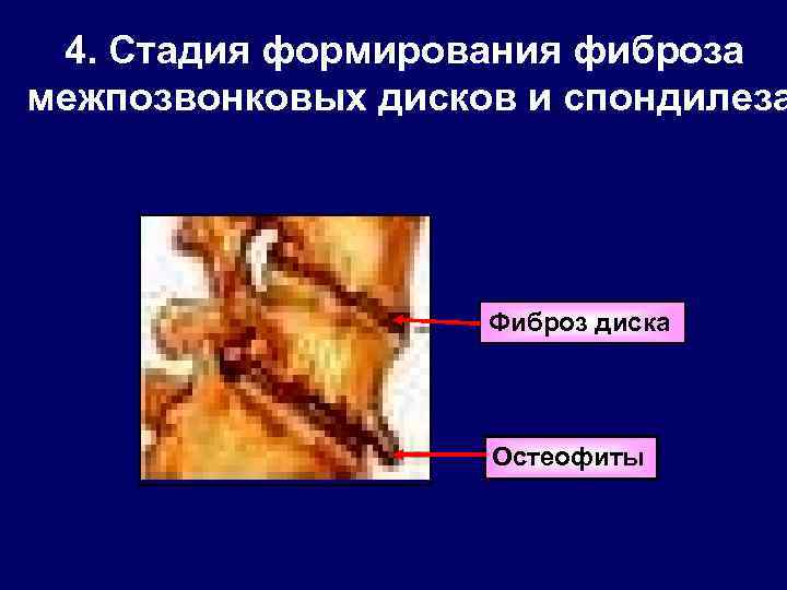 4. Стадия формирования фиброза межпозвонковых дисков и спондилеза Фиброз диска Остеофиты 