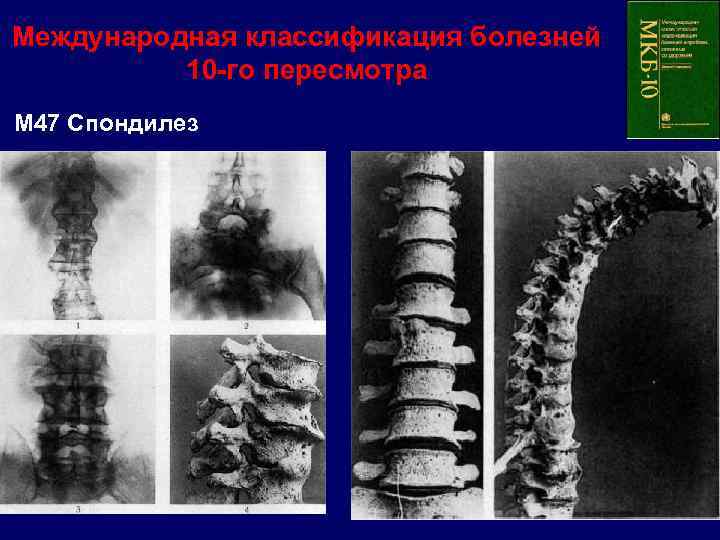 Международная классификация болезней 10 -го пересмотра M 47 Спондилез 