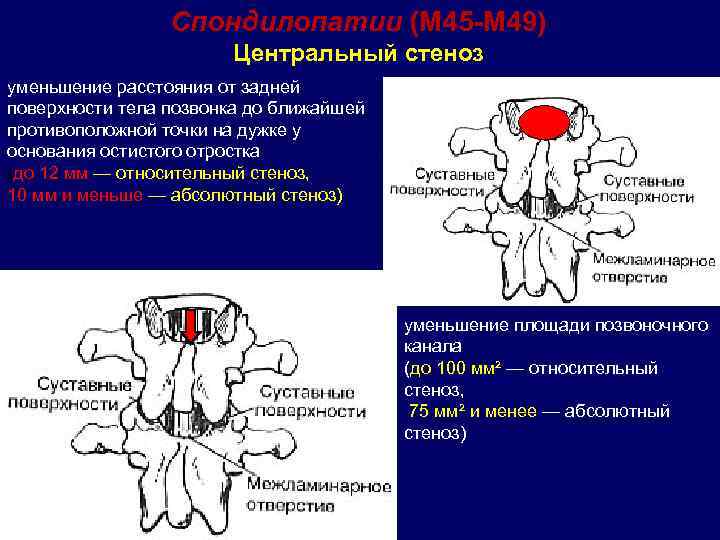  Спондилопатии (М 45 -М 49) Центральный стеноз уменьшение расстояния от задней поверхности тела