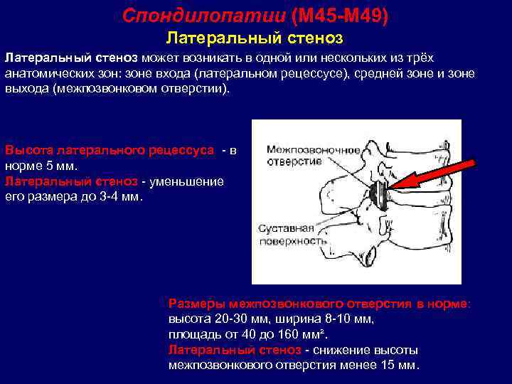  Спондилопатии (М 45 -М 49) Латеральный стеноз может возникать в одной или нескольких