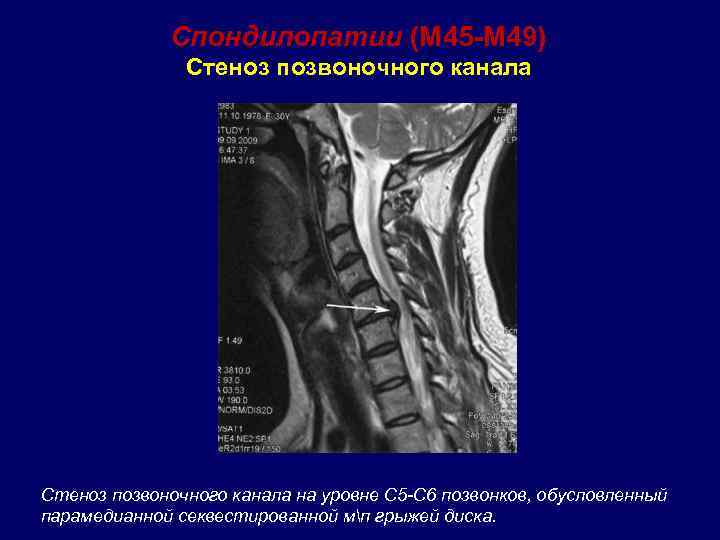 Стеноз позвоночного. Абсолютный Сагиттальный стеноз позвоночного канала l4-l5. Абсолютный стеноз позвоночного канала мрт. Стеноз позвоночного канала с4 с5.
