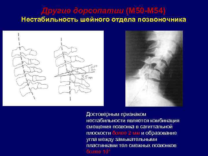  Другие дорсопатии (М 50 -М 54) Нестабильность шейного отдела позвоночника Достоверным признаком нестабильности
