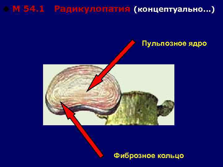 u М 54. 1 Радикулопатия (концептуально…) Пульпозное ядро Фиброзное кольцо 