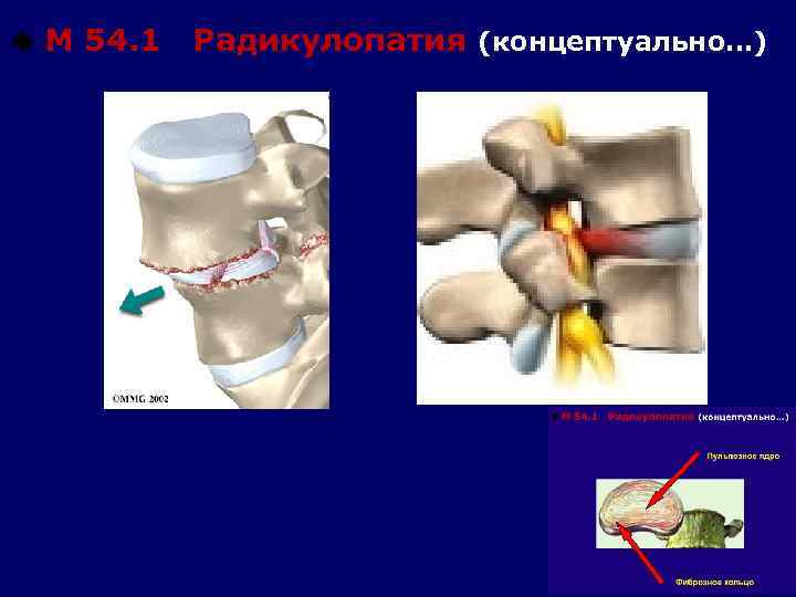 u М 54. 1 Радикулопатия (концептуально…) 
